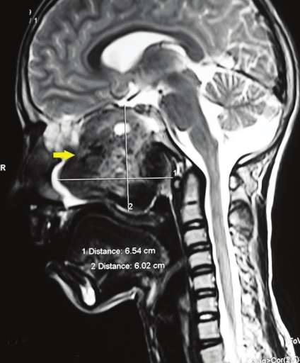 Sagittal section, T2-weighted magnetic resonance image shows a large, well-defined tumor mass (arrow) with a heterogenous intensity measuring 6.54 cm × 6.02 cm.